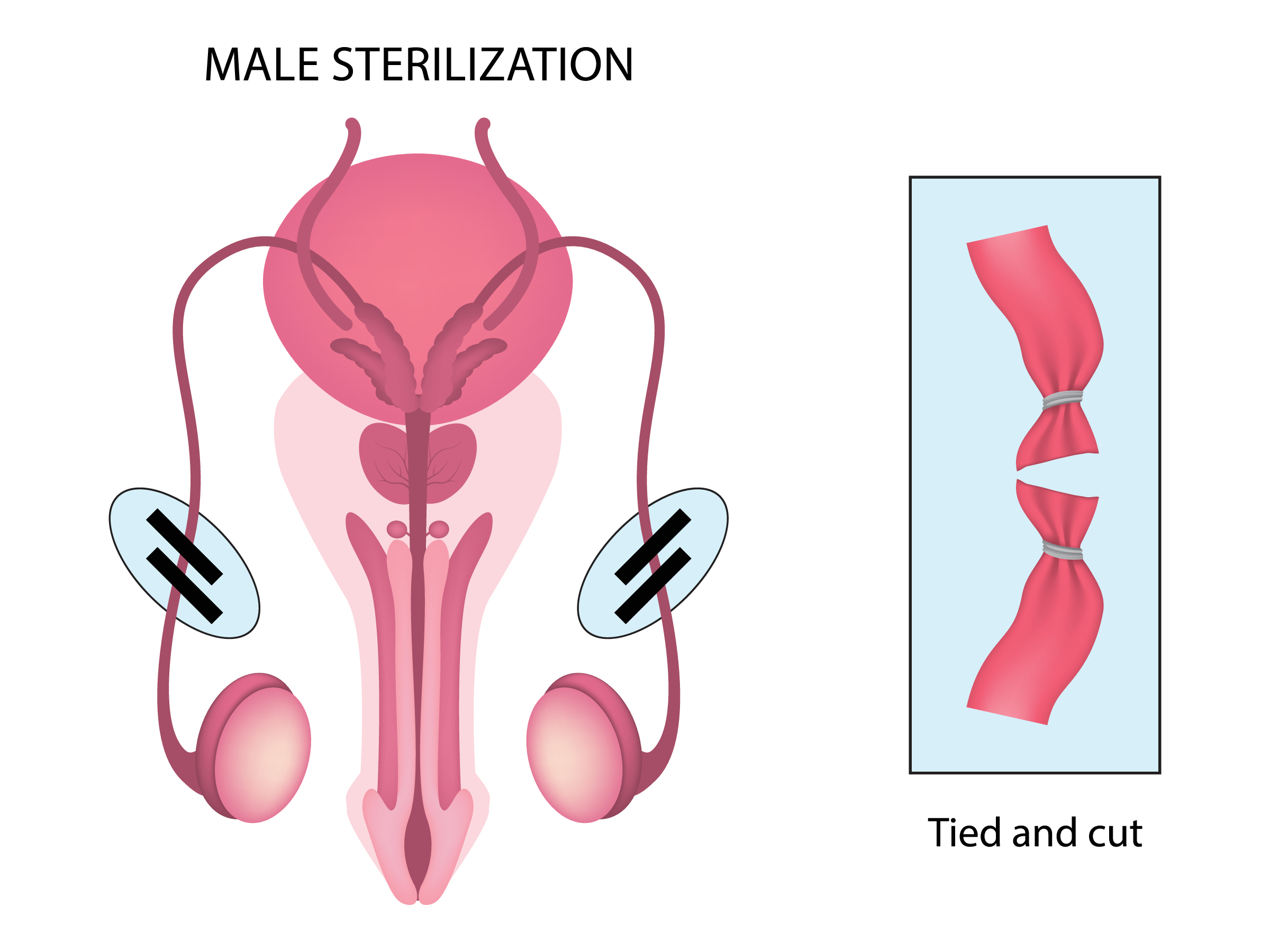 Male,Sterilization,,Vasectomy,Human,,Vector,Illustration,Eps10