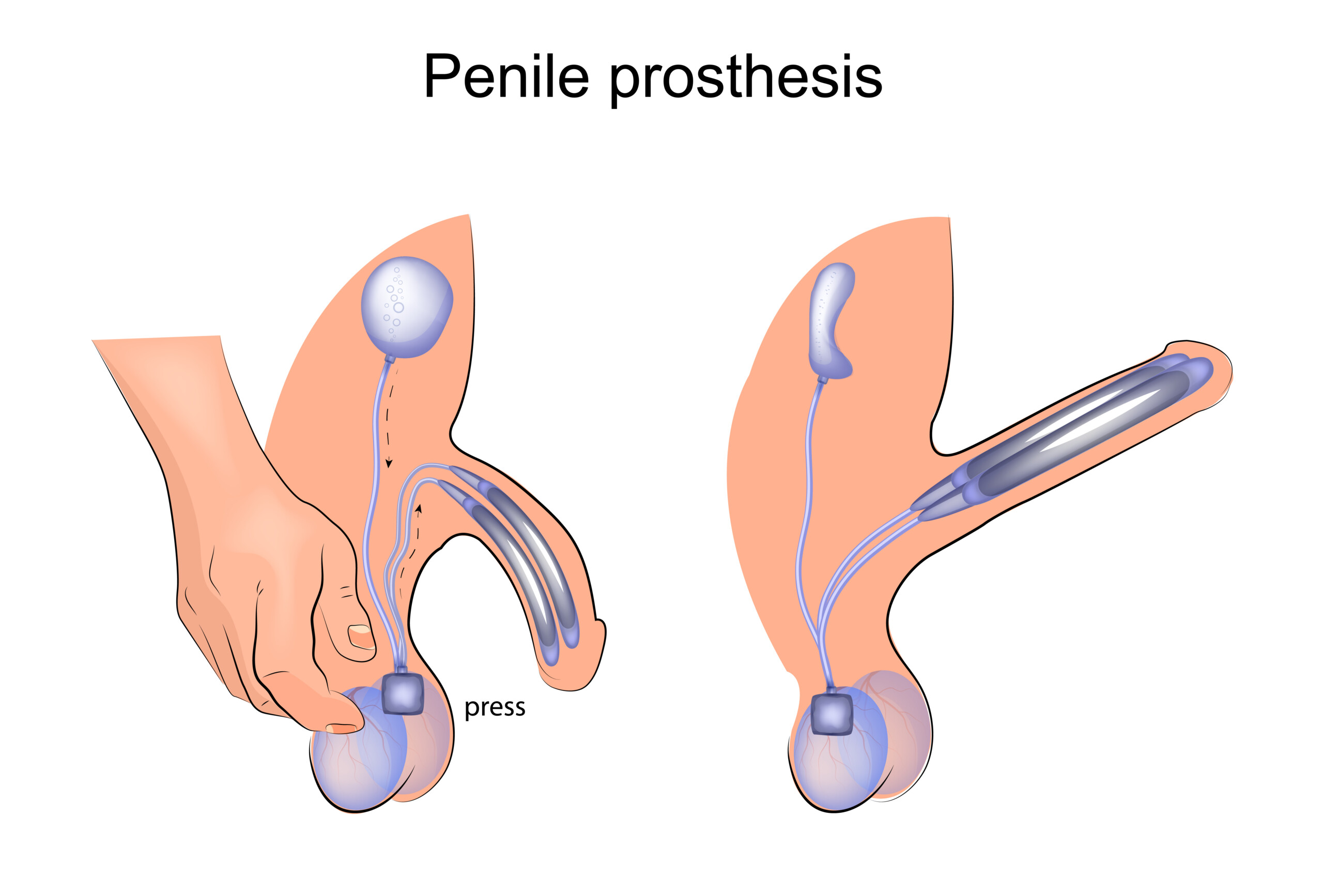 Vector,Illustration,Of,A,Penile,Prosthesis.,Urology